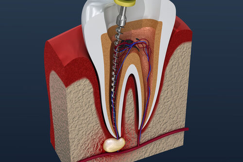 Endodonzia